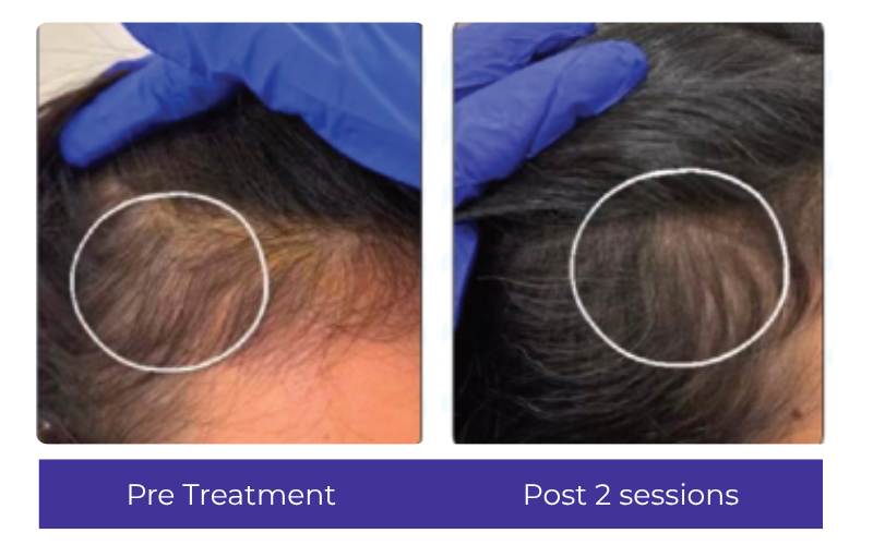 Hair result — crown restoration