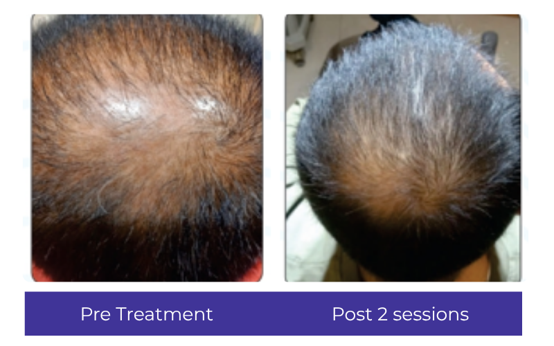 Hair result — visible improvement