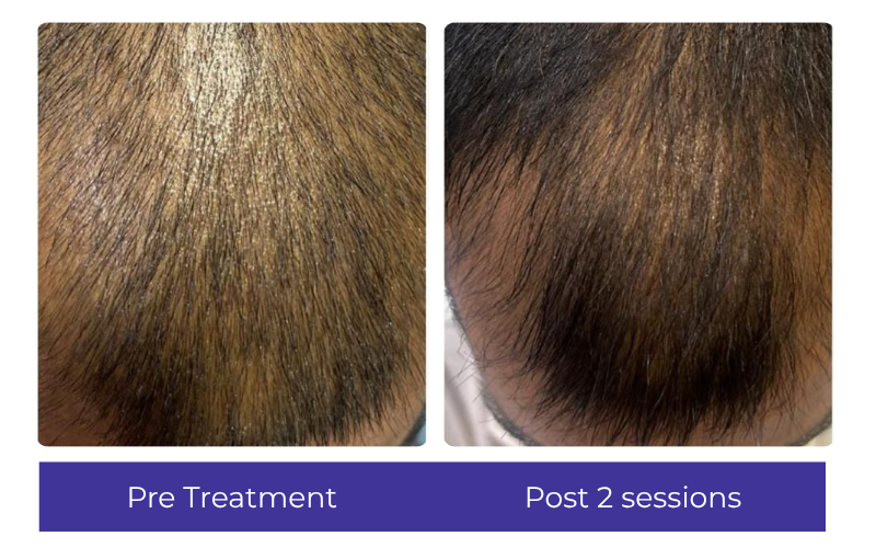 Hair result — visible improvement