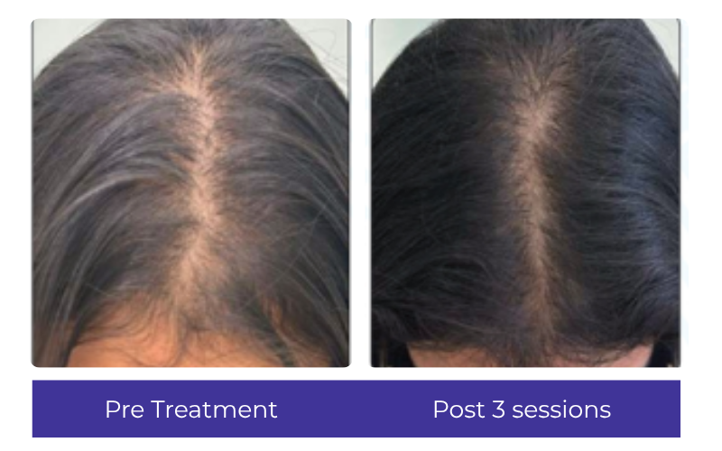 Hair result — thicker crown