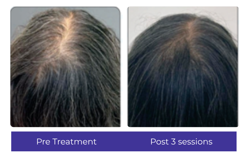 Hair result — part-line density