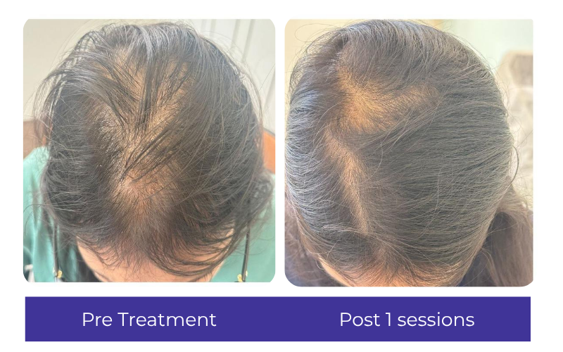 Hair result — visible improvement
