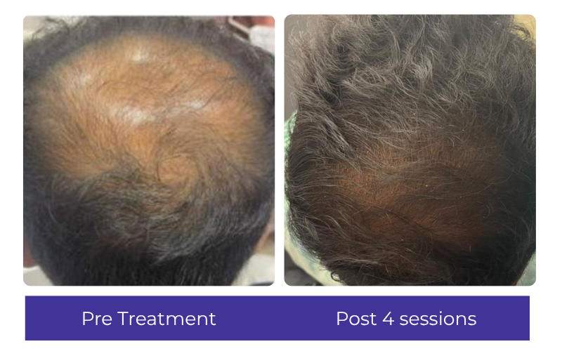 Hair result — visible improvement