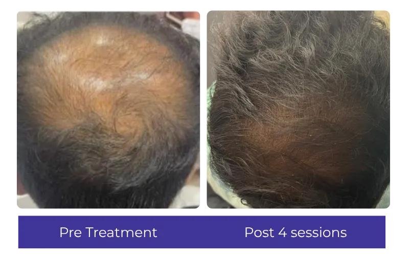 Before-After-5